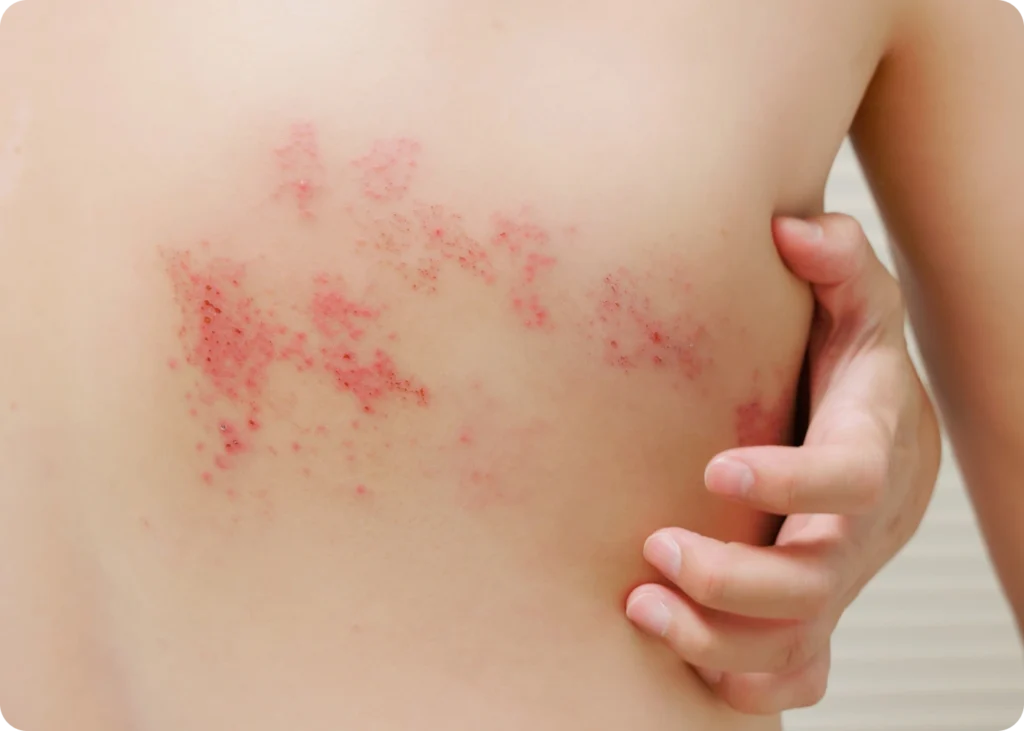 Shingles are a painful skin rash that are caused by the reactivation of the varicella-zoster virus. This product offer protection against shingles. Surevax Services.